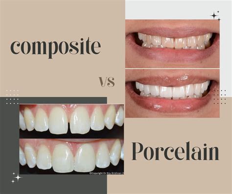 resin veneers|resin veneers vs porcelain.